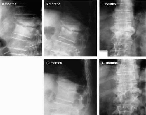 Figure 3. Three-month, 6-month and 12-month radiographs from a patient treated nonoperatively.