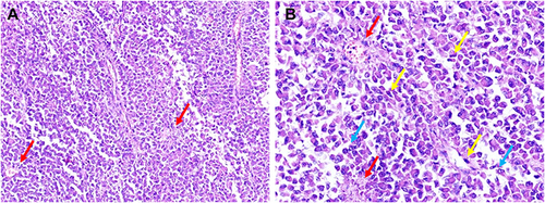 Figure 2 Hematoxylin and eosin (H&E) staining ((A): 100 ×, (B) 200 ×). Red arrows indicate the nested pattern of tumor cells around capillaries, blue ones indicate the apoptosis of tumor cells, and the yellow indicate the spindled cells.