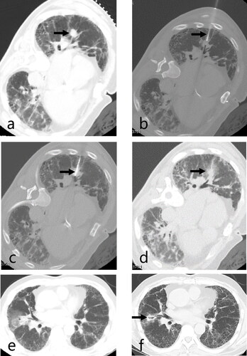 Figure 1. Axial CT images of a 64-year-old man with stage IA NSCLC (adenocarcinoma) with IPF who underwent CT-guided synchronous percutaneous CNB and MWA. (a) CT prior to MWA treatment shows a 1.9 × 1.2 cm lesion in the right lower lobe (arrow); (b), (c) CT findings during MWA treatment, a 15 G coaxial introducer needle (arrow) was advanced to the proximal edge of the lesion, and the antenna was positioned centrally through the cannula into the lesion (arrow); (d) CT image immediately post-procedure showed ground-glass opacity around the tumor (arrow); (e) CT image 24 h post-procedure showed the expected thermal damage around the target lesion, without pneumothorax. (f) CT image 6 months after MWA treatment showed a reduced ablation area (arrow), cavitation changes in the primary focus, and surrounding fibrotic scarring with signs of inflammation. CT: computed tomography; NSCLC: non-small cell lung cancer; IPF: idiopathic pulmonary fibrosis; CNB: core-needle biopsy; MWA: microwave ablation.
