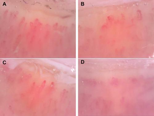 Figure 2 Nailfold capillaroscopy (200 x magnification): Capillary abnormalities revealing a “scleroderma pattern”: (A and B) architectural derangement with bushing and enlarged capillaries, (C) microaneurysms and (D) loss of capillaries.