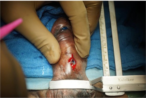 Figure 16 Peri-fistula incision in a case of urethrocutaneous fistula after hypospadias repair.