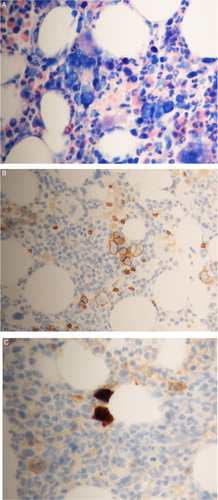 Figure 1 (A) Dysplastic BM erythropoiesis; intranuclear inclusion giant pronormoblasts (Giemsa). (B) Immunhistochemical contrasting of erythropoiesis: abnormal BM dysplasia, no aplasia. (C) Immunohistochemical detection of PVB19-positive cells in BM (antiPVB19 Ab)
