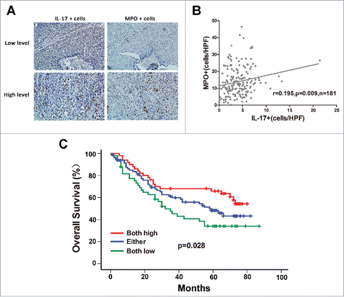 Figure 2. Correlation between MPO+ neutrophil infiltration and IL-17-producing cells in intratumoral areas of ESCC. (A) Immunohistochemical staining of MPO+ cells and IL-17+ cells in the same tumor tissues (Upper panel: sample 1; lower panel: sample 2). Original magnification, × 200. (B) Linear regression analyses suggest that there is a significantly positive correlation between the densities of MPO+ cells and IL-17+ cells in ESCC tissues. (C) Increased infiltration of both MPO+ cells and IL-17+ cells indicated better overall survival in ESCC patients.