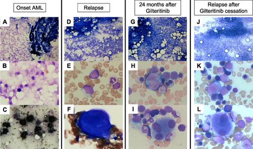 Figure 1 Bone marrow smear at onset of AML, first relapse of AML, 24 months after gilteritinib therapy, and relapse after gilteritinib cessation. (A and B) Wright–Giemsa (WG) staining at onset, showing extensive bone marrow necrosis. (C) Myeloperoxidase (MPO) staining at onset. (D–F) WG staining at first relapse, showing myeloblast increase without blood cell dysplasia. (G–I) WG staining at 24 months after gilteritinib therapy, showing multi-lineage blood cell dysplasia without myeloblast increase. (J–L) WG staining at relapse after gilteritinib cessation (35 months after gilteritinib treatment), showing a repopulation of myeloblasts against the background of multilineage dysplasia. Magnification is 100x for (A, D, G, and J), and 1000x for (B, C, E, F, H, I, K, and L).
