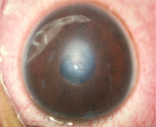 Figure 2 Right eye showing full thickness corneal laceration wound centrally with fibrin clumps in the anterior chamber located superotemporally.