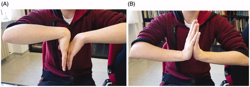 Figure 5. (A,B) This image displayed range of motion after 1 year.