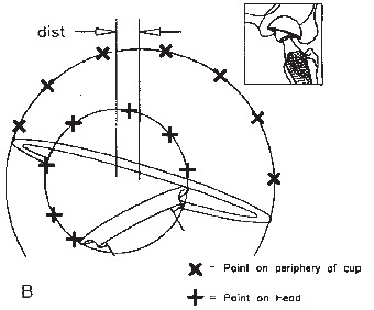 Figure 11.  Devane’s computer assisted method of PE wear measurement.