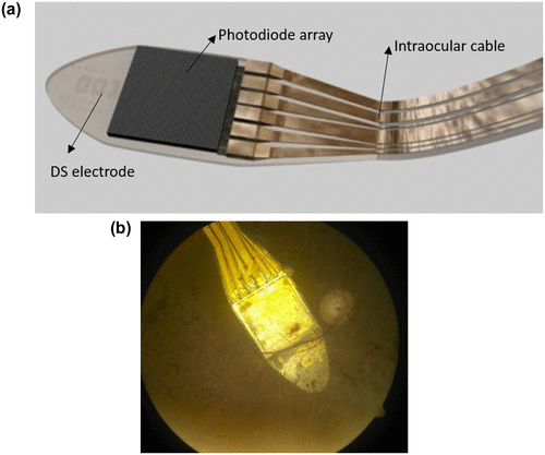 Figure 31. (a) Alpha IMS bionic implant. (b) Device implanted in the retina with a condition called retinitis pigmentosa. Source: http://www.vision-research.eu/index.php?id=868 and http://www.devicemed.de/index.cfm?pid=10749&pk=396919&fk=555109&type=article.