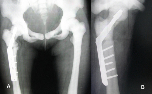 Figure 3 Postoperative radiographs of the pelvis (A, B) showed the right subtrochanteric femoral fracture with a dynamic hip screw and fracture of the right femoral neck.