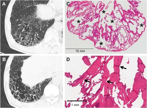 Figure 3 Severe SRIF with emphysema pattern on thin-section CT images and histological findings.Notes: (A and B) Thin-section CT images showing clustered cysts of markedly irregular size and shape accompanied by ground-glass attenuation with reticular structures in the surrounding area. (C) Low-power photograph of a histological section (hematoxylin–eosin stain) reveals irregularly shaped emphysematous spaces (asterisk) with collagenous fibrotic walls. Many of the walls are truncated. Patchy fibrosis is observed in the intervening lung parenchyma and corresponds to ground-glass attenuation with reticular structures on thin-section CT. Irregular cysts with thickened walls tend to be present a little apart from the pleura with less-involved subpleural lung parenchyma. (D) On this high-power photograph of a histological section, fibrosis consists of hyalinized paucicellular fibrosis (arrow) corresponding to SRIF.Abbreviations: SRIF, smoking-related interstitial fibrosis; CT, computed tomography.