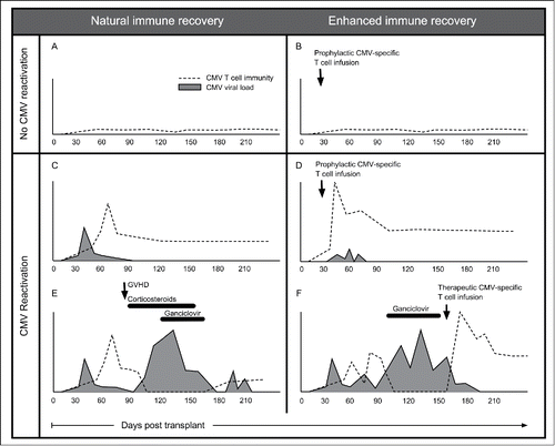 Figure 1. CMV immune recovery post-allogeneic HSCT. (A and B) Absence of CMV reactivation does not stimulate clonal expansion of CMV specific T cell clones and detectable CMV immunity is low or undetectable. When CMV-VSTs are administered prophylactically no expansion of the transferred clones is observed. (C and D) Low level CMV reactivation is controlled by CMV-VSTs that recover in the first few months post-HSCT. Prophylactic or pre-emptively administered CMV-VSTs are seen to expand in vivo and produce long-lasting stable immunity that is detectable up to 10 y after transplant. (E) CMV immunity recovers and controls CMV without treatment in the first few months. Subsequent development of GVHD and administration of corticosteroids and other immune suppressive medications results in loss of CMV immunity and recurrent CMV reactivation requires treatment with antiviral pharmacotherapy. (F) After failure to establish an effective cellular immune response spontaneously, either due to treatment (as in E) or donor seronegativity, donor-derived or third party banked CMV-VSTs administered therapeutically can rescue patients refractory to standard therapies.
