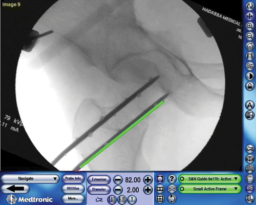 Figure 2. The validation phase. New images are taken after the insertion of the guide wires. The drill guide is placed over the wires and the navigated virtual image (green line) is superimposed on the “real” radiographic image (black line). The discrepancy between these images in both translation and angulation is calculated. [Color version available online.]