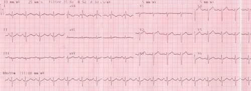 Fig. 1. Electrocardiogram (ECG) showing sinus tachycardia with poor R-wave progression in precordial leads.