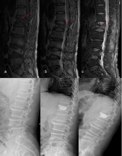 Figure 2 Typical case in the re-kyphosis group. A 67-year-old male patient complained of back pain for 10 days. T1-weighted (a), T2 -weighted (b) and fat-suppressed (c) MRI images showed bone marrow edema signal and disc–endplate complex injury of L1 vertebra(red arrow). Preoperative lateral X-ray image (d) showed multiple degenerative changes of lumbar spine. Lateral X-ray image 1 day after surgery (e) showed the vertebral height was restored and local kyphotic angle was corrected. Lateral X-ray image at the last follow-up (f) showed the occurrence of re-kyphosis.