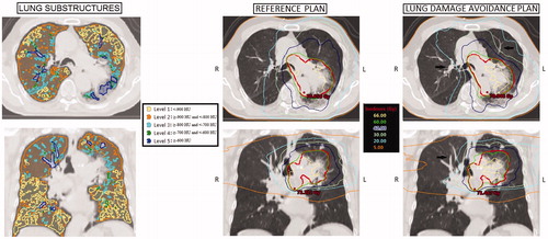 Figure 1. Example patient (number 8) with on the left the five planning CT density-based substructure segmentations within the ‘lungs minus GTV’ structure (named ‘Level 1’ up to ‘Level 5’). The substructures contain lung voxels <–900 HU (Level 1), between –900 HU and –801 HU (Level 2), between –800 HU and –701 HU (Level 3), between –700 HU and –601 HU (Level 4) and ≥–600 HU (Level 5). In the middle, the anatomy-based VMAT plan naive with respect to CT density heterogeneity in the lung volume is presented. Images on the right present the lung avoidance VMAT plan based on the Level 1 to 5 lung substructures, and applying density-specific dose objectives. Note the drastic isodose shifts (indicated by black arrows on the right axial and coronal slices) to achieve optimal sparing of some high-density components in the lung damage avoidance plan.