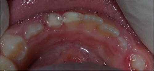Figure 2 Occlusal view of fractured teeth. Glass Ionomer Cement is covering the fractured teeth.