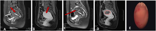 Figure 3. MRI Features of internal adenomyosis. (A) Internal adenomyosis: a lesion with ill-defined margin located in the anterior wall of the uterus had developed in the thickened junctional zone (black arrow) and the myometrium outside the adenomyotic lesion was preserved. The thickness of the intact myometrium was 4 mm (white arrow). (B) Pre-HIFU enhanced MRI showed an internal adenomyotic lesion located at the posterior wall of the uterus (arrow). (C) T2-weighted image 1 day after HIFU. (D) A contrast-enhanced MRI obtained 1 day after HIFU showed the internal adenomyotic lesion was ablated (circled). (E) A hysteroscopic showing a normal uterine cavity after 6 months. This patient achieved successful IVF whom underwent previous twice failed IVF that ended in uncomplicated cesarean deliveries at 40 weeks because of the advice of obstetrician.
