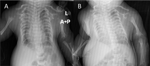 Figure 3 Chest and upper extremity radiographs reveal short horizontal ribs, a long and narrow thorax, severely shortened bones with round metaphyseal ends with lateral spikes, high clavicles, and severe pulmonary hypoplasia. Chest x-ray upon admission to the neonatal intensive care unit (A) and at age two weeks (B).