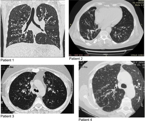 Figure 1 Chest CT scan before treatment (T0).