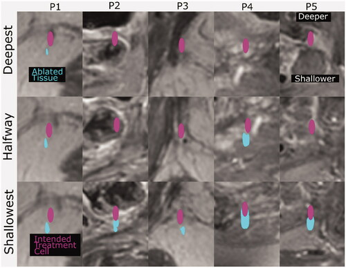 Figure 6. Cross sections of the ablated tissue (cyan), resulting from simulated sonication of the deepest, shallowest and halfway reachable treatment cells (magenta, 4 mm wide and 10 mm long centered at the geometric focus), overlaid on patient anatomy (grayscale in-phase MR image). The image slices are those with the largest ablated cross-sectional area. The ablated tissue volumes’ distances from the geometric focus, in all three dimensions, are quantified in Table 4.