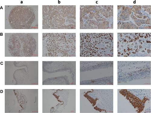 Figure 1 (A) Low expression of KRT17 in cancer tissues (a, magnification, ×4; b, magnification, ×10; c, magnification, ×20; d, magnification, ×40). (B) High expression of KRT17 in cancer tissues (a, magnification, ×4; b, magnification, ×10; c, magnification, ×20; d, magnification, ×40). (C) Low expression of KRT17 in the adjacent tissues (a, magnification, ×4; b, magnification, ×10; c, magnification, ×20; d, magnification, ×40). (D) High expression of KRT17 in the adjacent tissues (a, magnification, ×4; b, magnification, ×10; c, magnification, ×20; d, magnification, ×40).