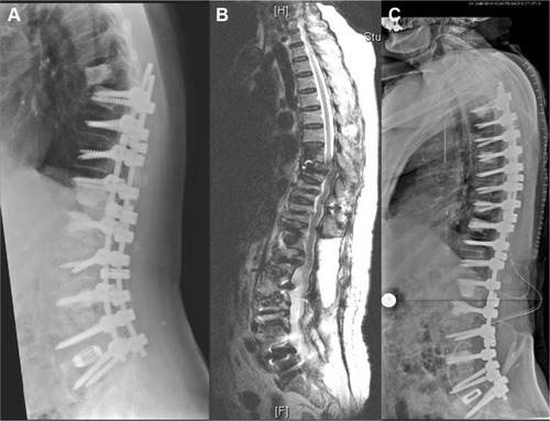 Figure 3 (A) Lateral radiograph demonstrating vertebral subluxation of T8 with proximal junctional angle of 36° (T7-T9) 19 days after previous surgery; (B) magnetic resonance image showing T8 subluxation with severe cord compression; (C) the third immediately postoperative radiograph.