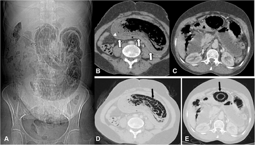 Figure 1 (A) Scout image of abdomen showing linear low density streaking along the wall of bowel loops (arrow) indicating pneumatosis of small bowel. (B–E) Axial CT of the upper abdomen with soft tissue and lung windows showing long segment small bowel intussusception of proximal small bowel loops, jejunal loops (white arrows) with intramural air (black arrows). The wall of intussusceptum is imperceptible with faint contrast enhancement (White arrow head). The transition point of the intussusception is seen collapsed without lead point (Black arrow head). Proximal small bowel loops are dilated.