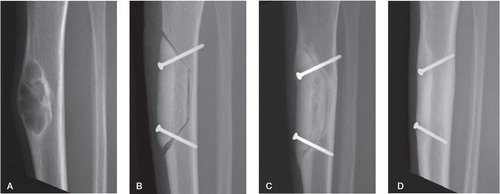 Figure 3. Radiographic series of the first patient. A. OFD-like AD lesion in situ. B. Immediately postoperatively. The graft and the host resection planes are both smooth and in close proximity. The distal point of the host bone has a small defect, most probably created by the vibrations of the saw blade. The remaining gap is filled with Vitoss (Orthovita Inc., Malvern, PA). C. Progressive ingrowth after 5 months. Cortical hypertrophy is clearly visible. D. Full integration and almost entirely faded boundary line at 16 months.