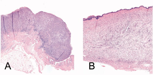 Figure 3. (A) HE-staining (50× magnification) showing high-grade urothelial carcinoma invading the muscularis propria (T2) in a rat of the control group; (B) HE-staining (40× magnification) showing edema and inflammatory cells in the bladder submucosa in a rat of DPPG2-TSL-DOX with HT group, indicating possible prior tumor localization.