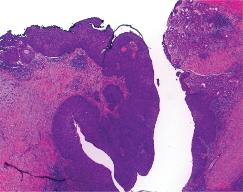 Figure 6 Higher power magnification (hematoxylin and eosin stain x80). Distinct features of transitional cell carcinoma were noted on microscopy with focal squamous differentiation (nonkeratinising cell carcinoma) High grade in situ carcinoma extended superiorly along both lacrimal canaliculi and inferiorly along the nasolacrimal duct. All margins were clear with appearance of complete excision.