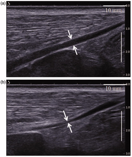 Figure 7. Ultrasound images of a sheep vein before (a) and immediately after HIFU treatment (b) showing luminal shrinkage and blurred vascular contours.