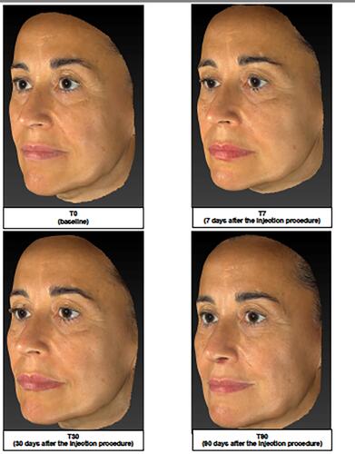 Figure 3 Representative image analysis of improvement of midface volume before treatment (T0), 7 days (T7), 30 days (T30) and 90 days after injection of the brand-new intracutaneous filler. The subject’s midface was evaluated by mean of Vectra H1.