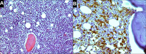 Figure 4 (A) Biopsy of the bone marrow (2018) shows hypercellular, relative to the age norm, bone marrow. The bone marrow contains approximately 20% adipose tissue (H&E, x200). (B) CD3 staining shows infiltration by small T-cells with irregular nuclei (x400).
