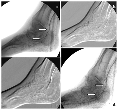 Figure 4 Selective revascularization of the distal posterior tibial artery and its appended medial plantar artery angiosome. (a) and (b) Selective angioplasty in the posterior tibial artery, and (c) and (d) specific revascularization of the medial plantar artery and its angiosome.
