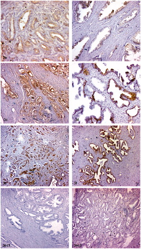 Figure 3. Immunohistochemical staining intensity scores. Prostate adenocarcinomas and non-malignant areas in same tissue sections stained with anti SP-A antibody (a) 1+ staining, (c) 2+ staining (e) 3+ staining. Non-malignant areas stained with anti SP-A antibody (b) 1+ staining, (d) 2+ staining (f) 3+ staining. Negative staining (nc1) of prostate adenocarcinoma, negative control staining of non-malignant areas (nc2). Note: Original magnifications of images; (a) 200×, (b) 50×, (c) 100×, (d) 100×, (e) 50×, (f) 50×, nc1; 50×, nc2: 100×.