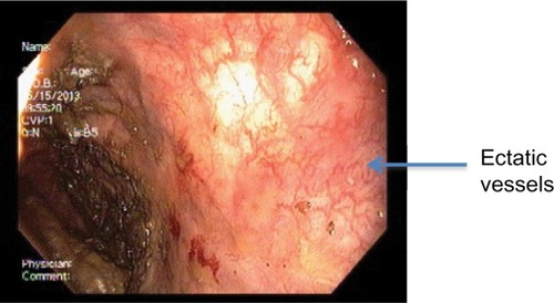 Figure 3 Radiation proctopathy (case 2).