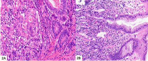 Figure 2 Pathological morphology. (A) gastric adenocarcinoma HE X200 (B) gastritis HE X200.