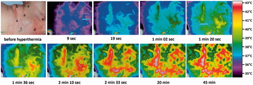 Figure 3. Thermographic control of wIRA-hyperthermia in a patient with inflammatory breast cancer recurrence. Before start of heating: (a) visible inflammatory disease, (b) scar of the former tumourectomy, (c) field-mark for RT, (d) subcutaneous venous drainage, and (e) sebaceous retention cyst. Immediately after start of hyperthermia and within 19 s the venous drainage increases and transports heat away (cooling effect). After a few minutes this effect is clearly visible, then a breakdown of blood flow can be seen (after 2.5 min). These latter effects disappear after 3 min. Inflammatory recurrence and/or scarred tissue are heated up to 43 °C after 2.5 min and stay at this higher temperature level during the whole treatment period (see the bottom line at 20 and 45 min).