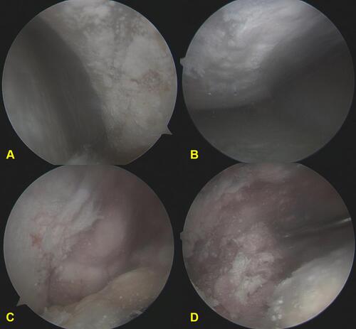 Figure 4 Arthroscopic finding: (A) Abundant crystal urate attached to the entire surface of synovium; (B) Crystal urate envelop the articular surface; (C) Intraarticular tophus formation; (D) Crystal urate comes out from the broken tophus.