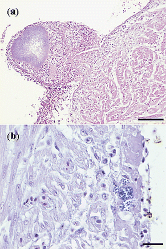 Figure 4. Haematoxylin and eosin sections of hearts with E. hirae-associated endocarditis showing (a) fibrinous thromboendocarditis of the right atrioventricular valve: the vegetative lesion is covered by a thrombus with erythrocytes, fibrin and accumulations of cocci, mural attachment of the vegetative process is present and the myocardium seems unaffected (bar = 100 µm), and (b) a subendocardial lesion, with numerous cocci, embedded in fibrillar eosinophilic proteinaceous material (fibrin): some inflammatory cells are present and the myocardium seems unaffected (bar = 20 µm).