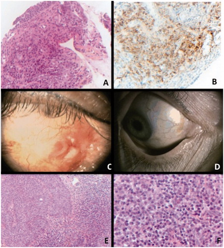 FIGURE 2. Conjunctival biopsy of case 2. Panel A: Haematoxylin eosin staining, x200 magnification. Presence of a lymphoplasmocytic infiltration of the conjunctiva. Panel B: IgG4 immunostaining, x200 magnification.Diffuse staining is observed in the sample, composed with 85% of plasmocytes. Panel C: Clinical picture of patient 2 demonstrating conjunctival inflammation relapsing with in situ carcinoma after steroids treatment. Panel D: Complete regression of the carcinoma after 2 cycles of topical mytomicin. Panel E: Conjunctival biopsy of case 2 after apparent relapse of inflammation. Haematoxylin x100 left: epithelial dystrophy without crossing the basal membrane (in situ carcinoma), adjacent to a large lymphoplasmocytic infiltration. Panel F: x400 magnification. Plasmocytes with typical feature of cartwheel nucleus and light appearance of cytoplasm.