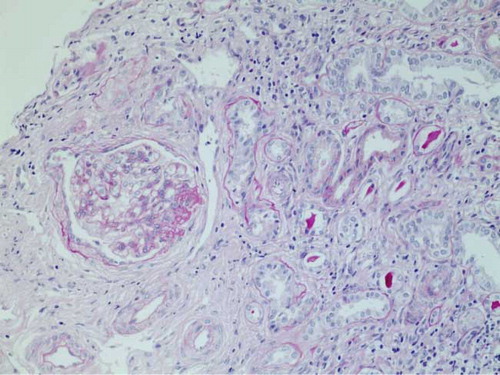 Figure 1. Renal biopsy of Patient 1 showing a globally sclerosed glomerulus with interstitial fibrosis and tubular atrophy (PAS stain; Magnification 200x).
