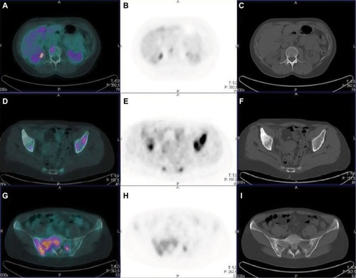 Figure 2 Comparison between PET and CT in different types of bone lesions.