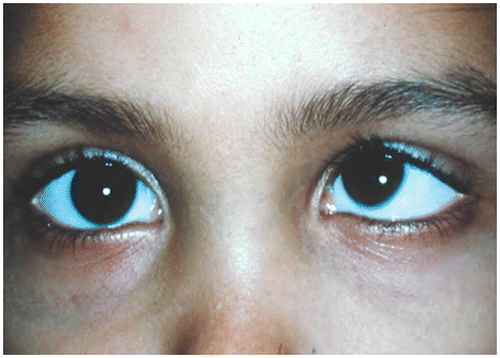 Figure 3: Left esotropia and hypertropia