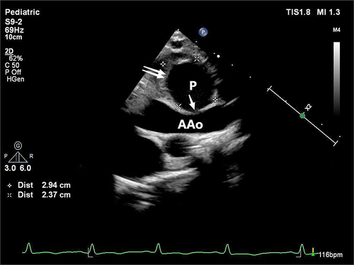 Figure 1 Ultrasound image showing the tumor-like structure of the mycotic pseudoaneurysm in the ascending aorta, with a thick wall and low-echoic material deposition within. Single arrow: rupture site; Double arrows: mural thrombus, which showed up on the echocardiogram as low-echoic material deposition. The distance between the two crosses symbols was 2.94cm; The distance between the two crosshair symbols was 2.37cm.