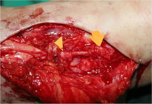 Figure 2 Excision of the hypersensitive painful skin and vein wrapping of superficial peroneal nerve (between arrow head and arrow).