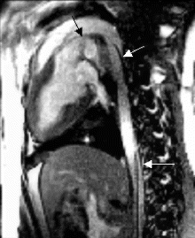 Figure 1. real-time TrueFisp of 8F passive guiding catheter in aortic root. Arrows indicate location of catheter.