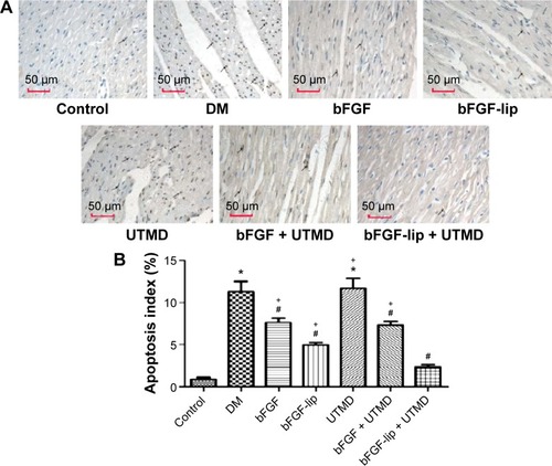 Figure 4 Prevention of DM-induced cardiomyocytes apoptosis under bFGF-lip treatment.Notes: (A) Representative pictures of TUNEL assay (400×, arrow indicates TUNEL-positive cardiomyocytes stained in brown); (B) quantitative analysis of cardiomyocyte apoptosis index. N=8 per group. Data are expressed as mean ± SD. *P<0.01 vs control group; #P<0.01 vs DM group; +P<0.05 vs bFGF-lip + UTMD group.Abbreviations: DM, diabetes mellitus; SD, standard deviation; bFGF, basic fibroblast growth factor; bFGF-lip, bFGF-loaded liposome; UTMD, ultrasound-targeted microbubble destruction; TUNEL, Terminal deoxynucleotidyl transferase (TdT)-mediated dUTP nick-end labeling.