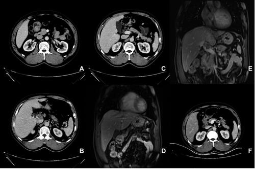 Figure 1 CT and MRI scan results for the patient before treatment (A–E) and after treatment (F). (A) There was a diffuse, uneven thickening and abnormal enhancement in pyloric area which was approximately 22×24 mm in diameter under CT scan. (B–E) Cancerous thrombi were detected in hepatic portal vein (CT and MRI, respectively). (C and D) Cancerous thrombi were detected in left gastric vein (CT and MRI, respectively). (F) CT scan result after treatment.