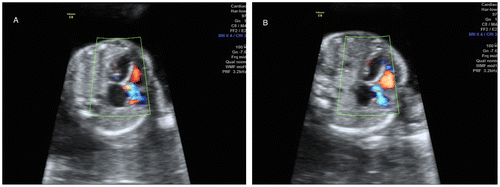 Figure 2. Male fetus. There is no filling of the left ventricle (A, B).